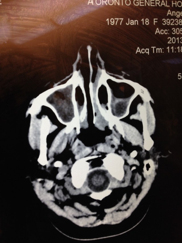 In case you were wondering what a CT scan of a sinus cold looks like.